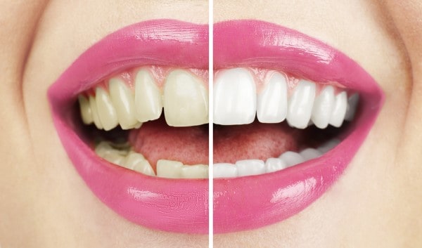 What Makes Ultima White Teeth Whitening Different Slough