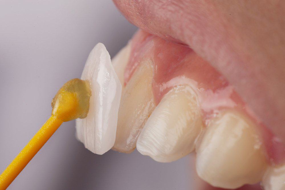 Why Do Dental Crowns Fail or Get Damaged Prematurely Slough?