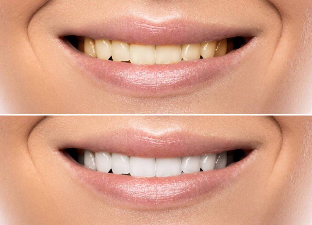 How Does Gum Disease Progress if Left Untreated Slough?