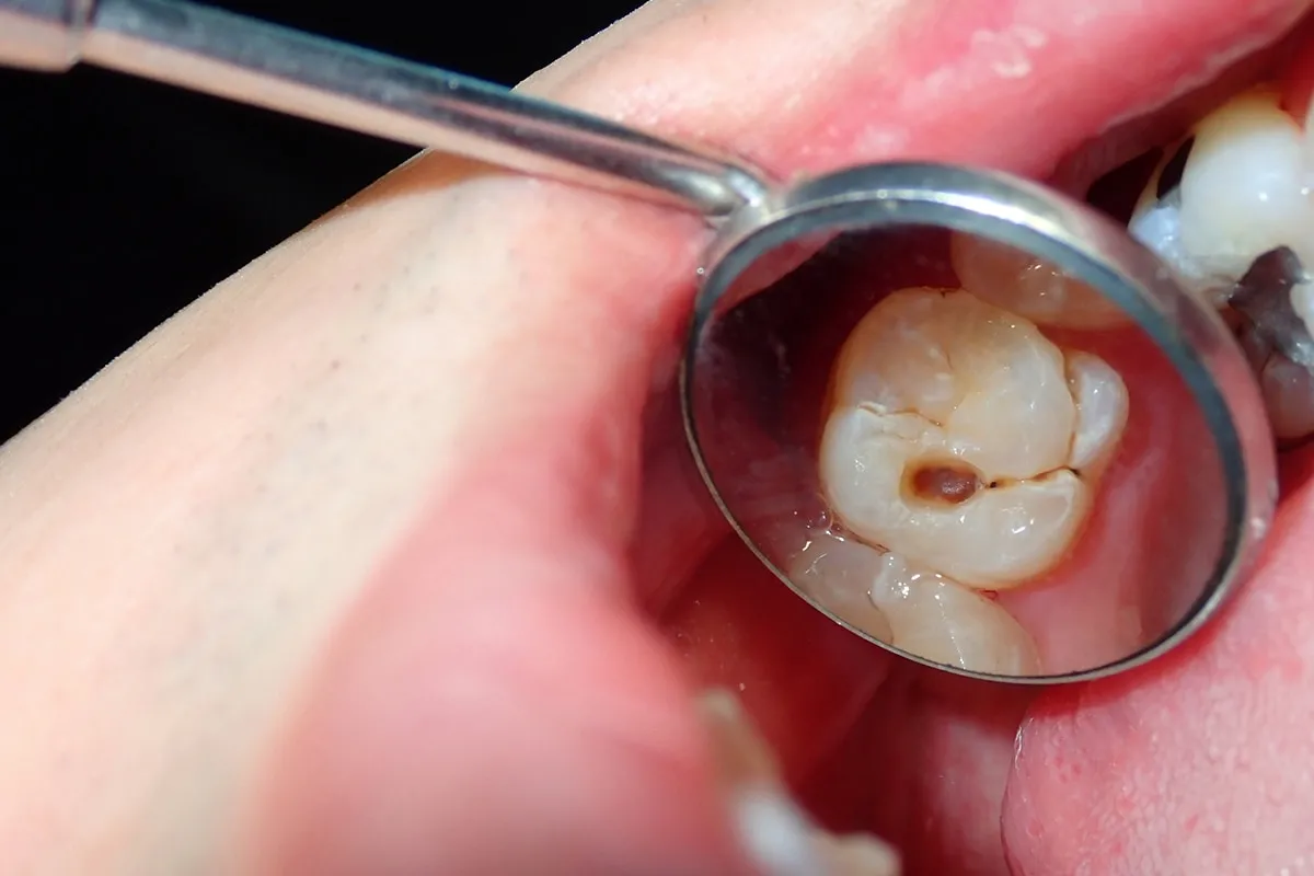 Why Do Teeth Crack? Common Causes to Know Slough