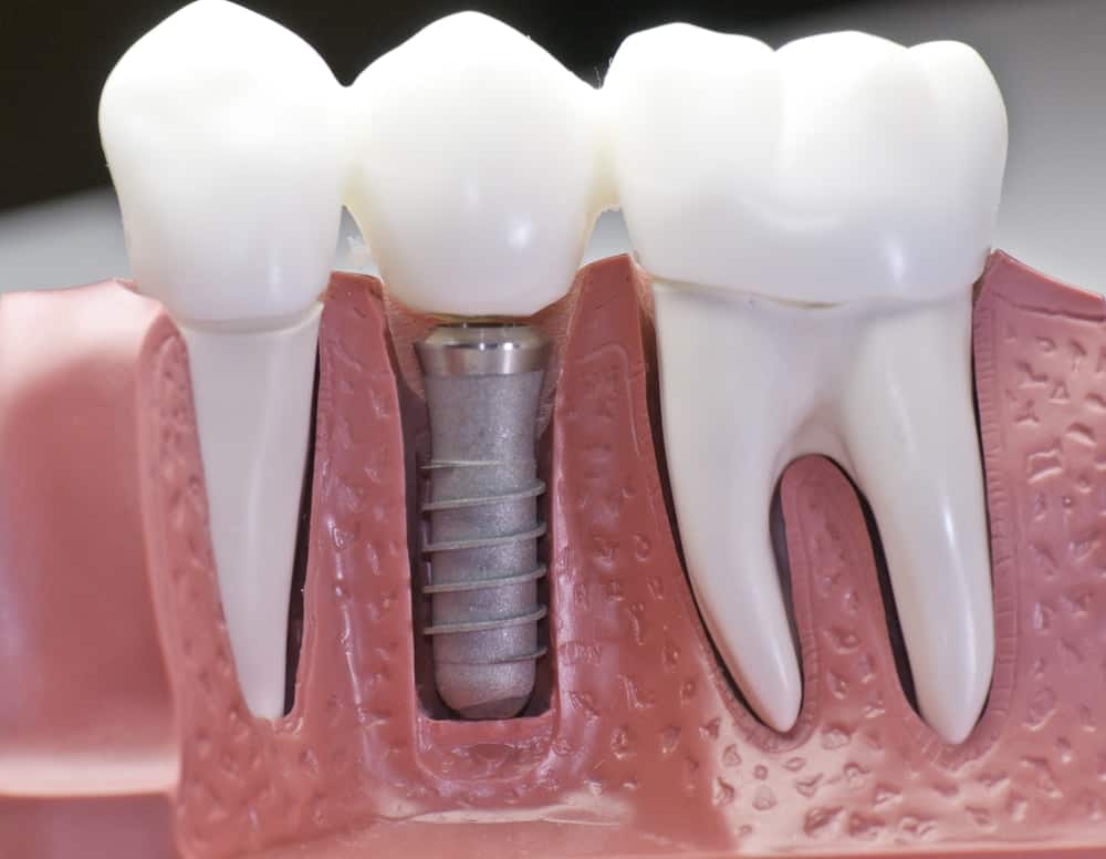 Dentures