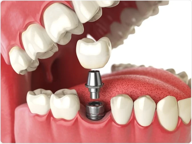 How Do I Decide Which Tooth Replacement Is Right for Me Slough?