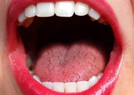 Common Causes of Dry Mouth (Xerostomia) Slough
