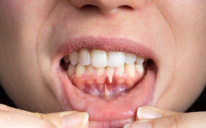 How Can Gum Disease Be Prevented Slough?
