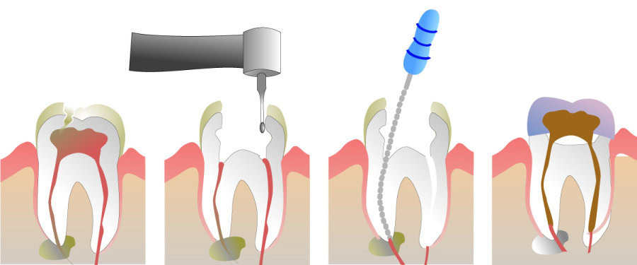 How Do You Properly Care for Your Teeth After a Root Canal Slough