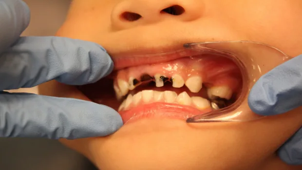 Which Foods and Drinks Cause the Most Damage to Young Smiles Slough?