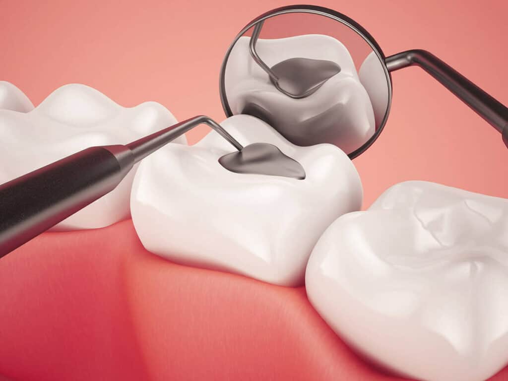 How Can You Prevent Tooth Decay Effectively Slough
