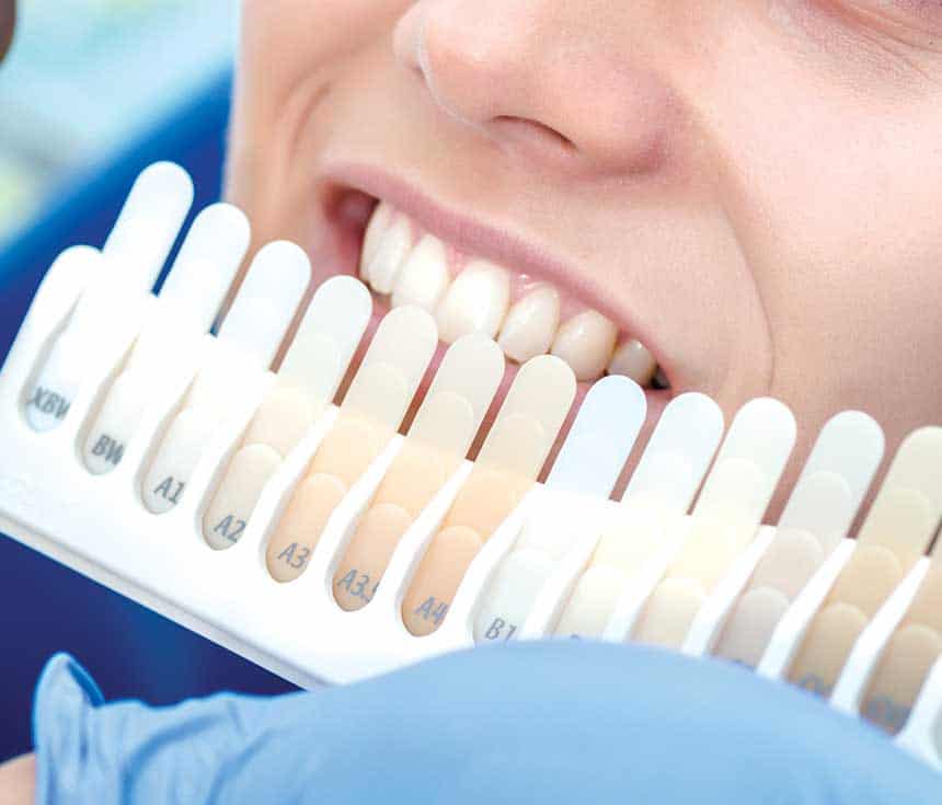 Is Laser Teeth Whitening Worth It for a Brighter, Confident Smile Slough?