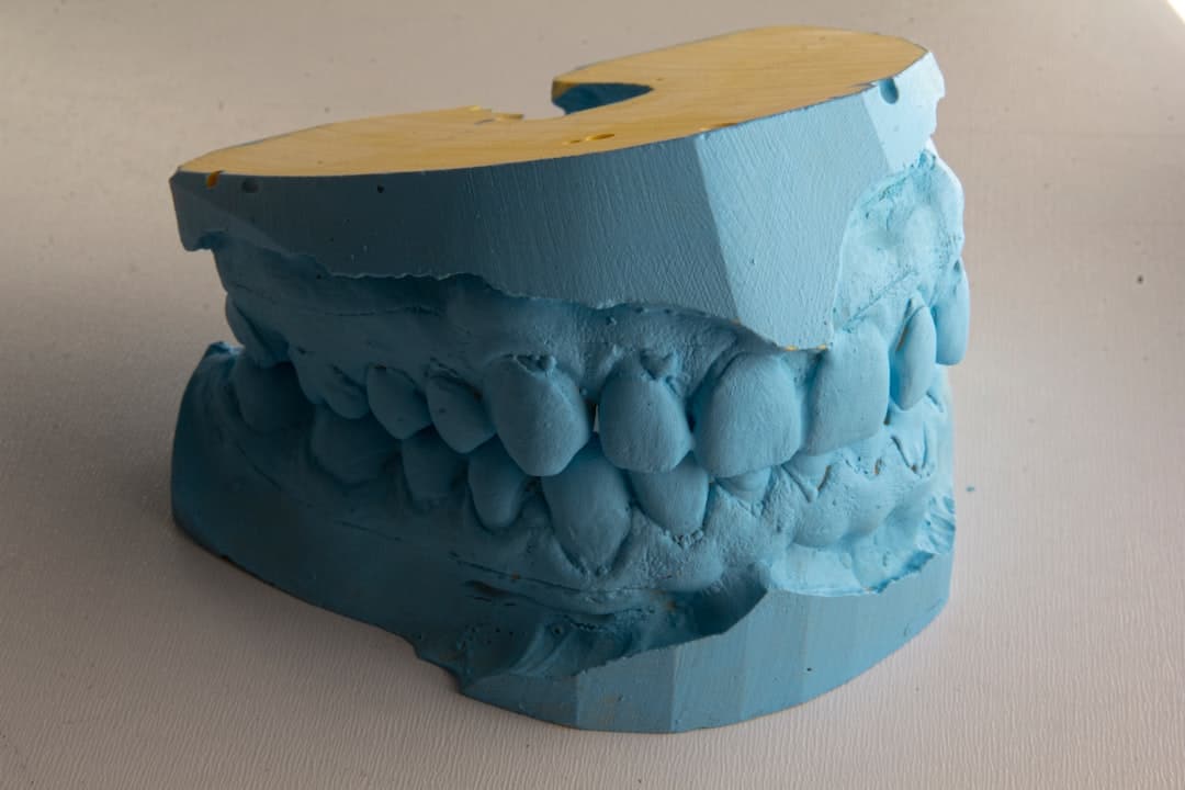 How Do Dental Implants Improve Jawbone Health and Oral Function Slough?