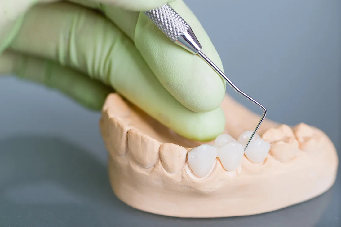 What Are the Different Types of Dental Crowns Available Slough?
