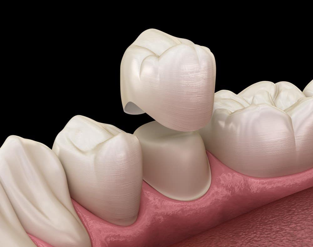 How Can You Prevent Common Dental Crown Problems Slough?