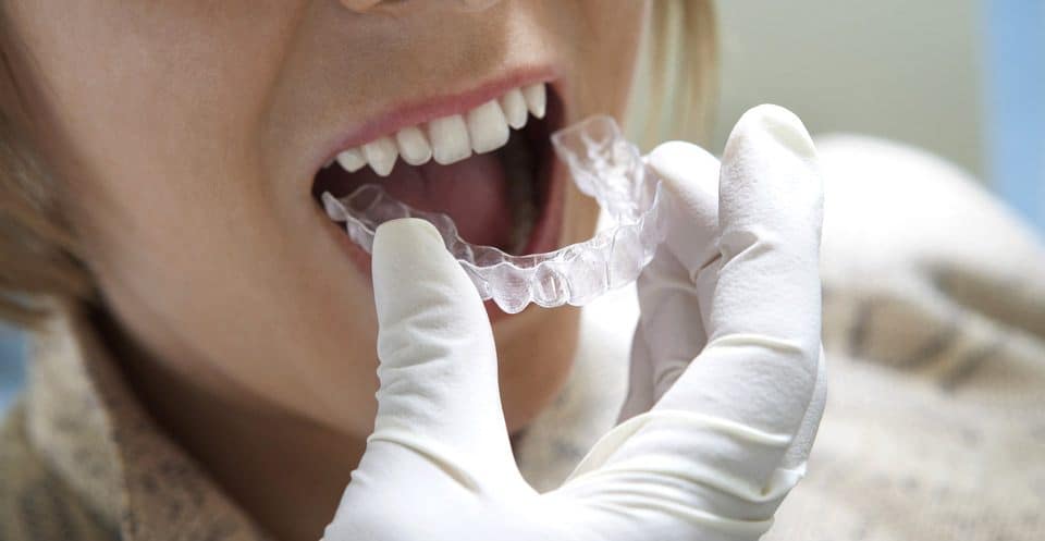 Why Bleaching Trays Require More Time Slough