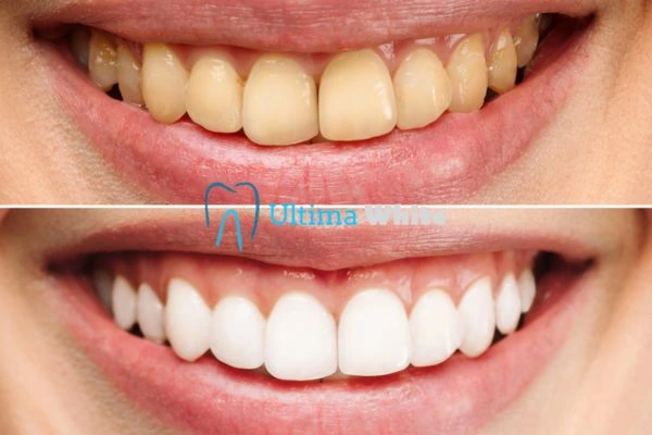 Oral Care Tips for Current and Former Smokers Slough
