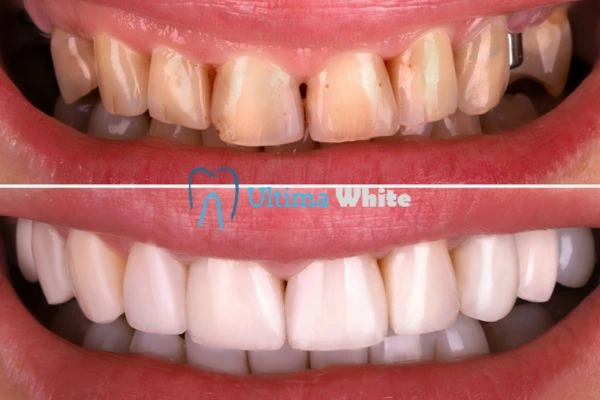 What Makes Instant Teeth Whitening Treatments So Popular Slough?