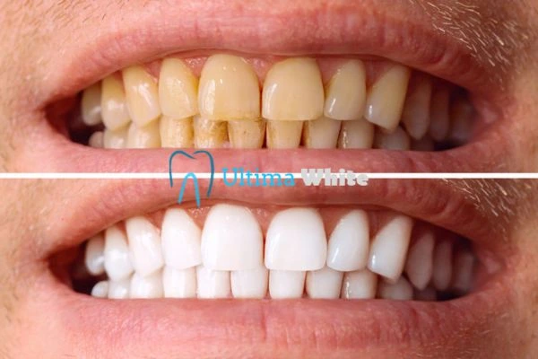 Stained Teeth and Persistent Bad Breath Slough